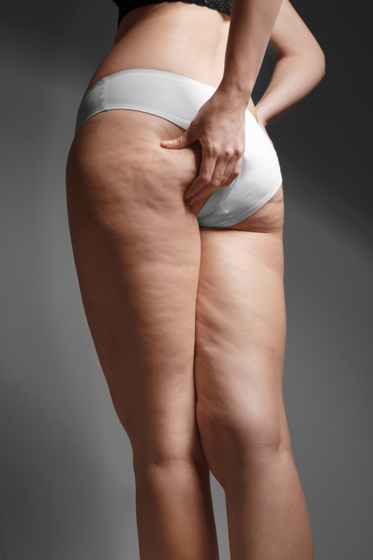 Person in Their Underwear with Stretch Marks